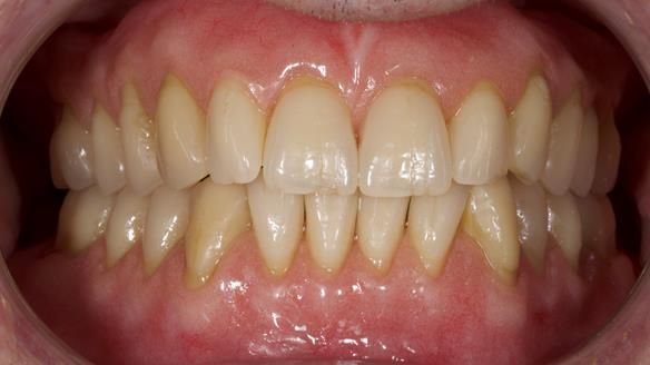 Newsletter 80 - Gordon’s dentures: the one case in 1,000 where my technique failed