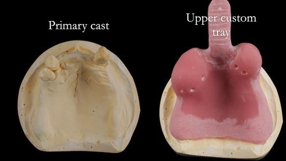 Finlay's Newsletter 59 Ultra hard partial dentures made for Gill
