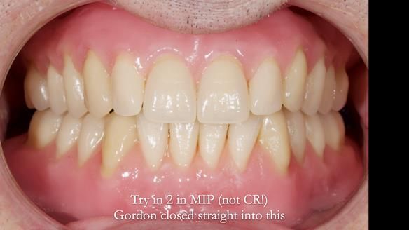 Newsletter 80 - Gordon’s dentures: the one case in 1,000 where my technique failed