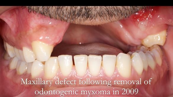 Upper metal base partial denture/occlusal stabilisation splint/obturator - full protocol