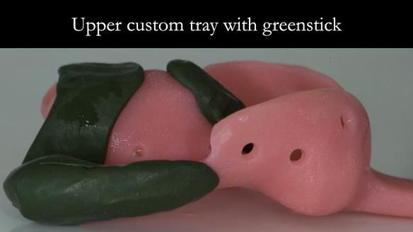 Newsletter 51 Managing Anne’s failing dentition with distal extension base RPD/Splint FULL PROTOCOL