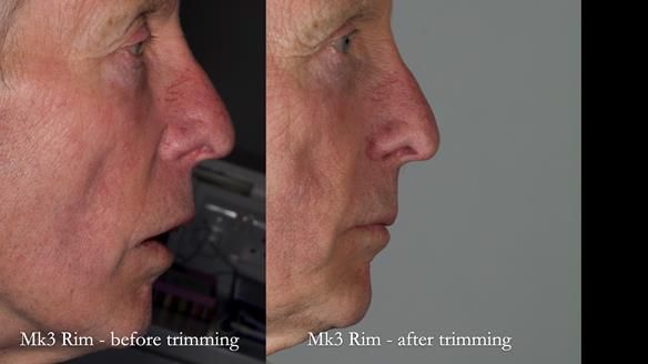 Newsletter 77: Jeremy’s case – immediate complete upper denture