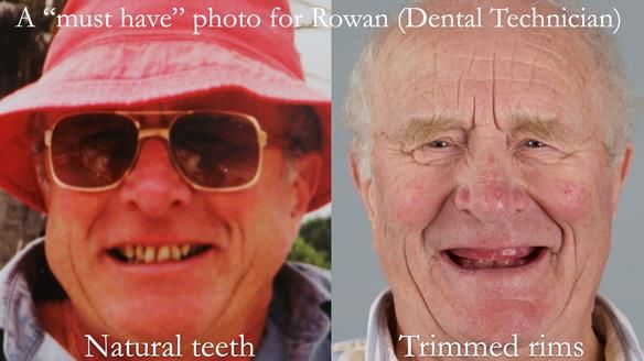 Complete denture Class II div 2 deep overbite Newsletter 39