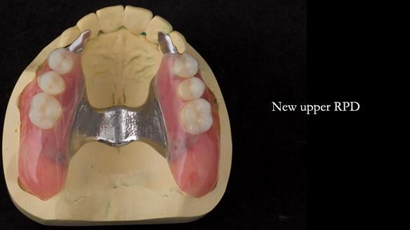 Newsletter 76: Jackie’s case – Telescopic overdenture & precision RPD (the tricky truth!)
