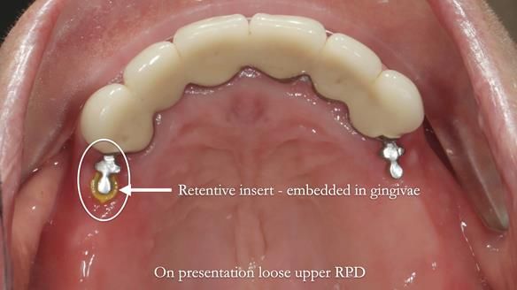 Newsletter 76: Jackie’s case – Telescopic overdenture & precision RPD (the tricky truth!)