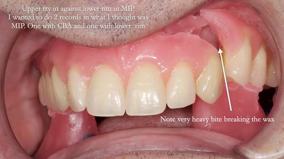 Newsletter 80 - Gordon’s dentures: the one case in 1,000 where my technique failed