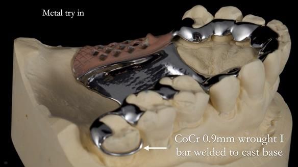 Finlay's Newsletter 64 case study - provision of a Kennedy class 2 metal based Scandinavian RPD for Ian