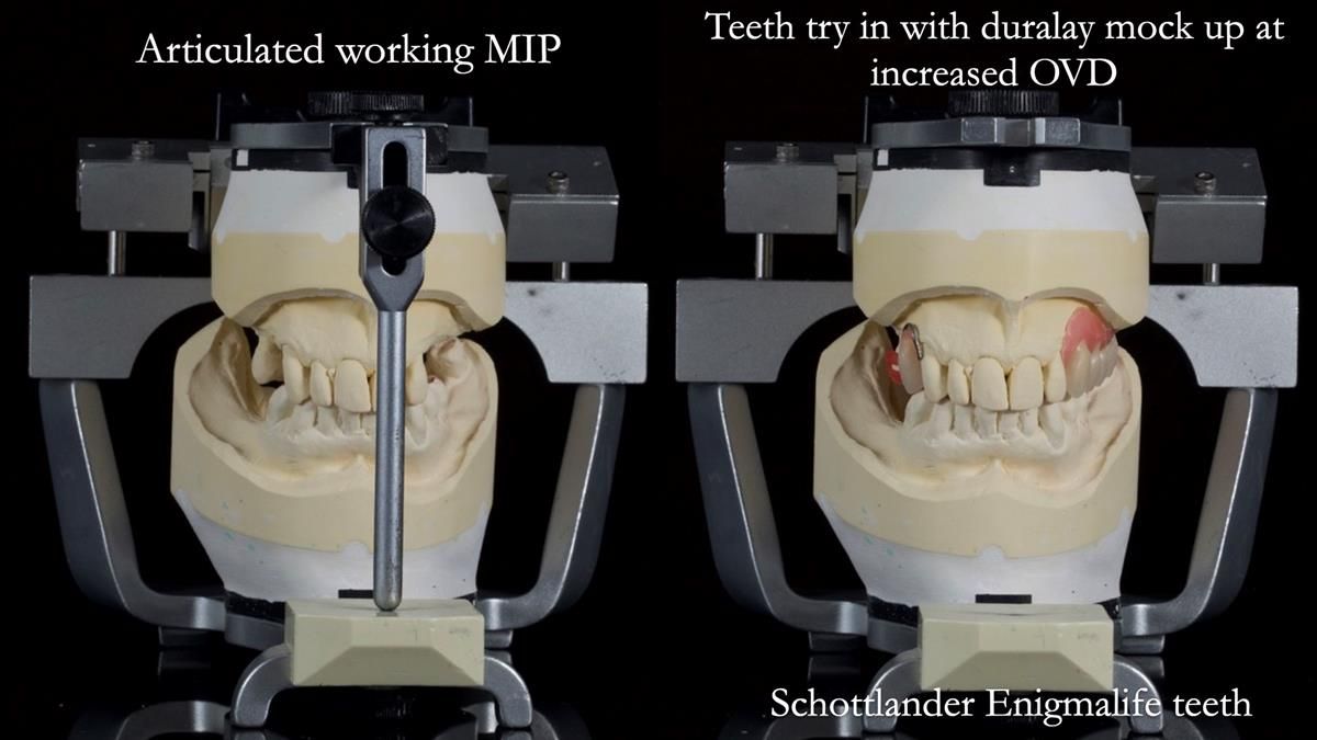 Newsletter 89 – Simon: A Challenging Kennedy Class II Division 1 Upper CoCr Partial Denture with a High Smile Line
