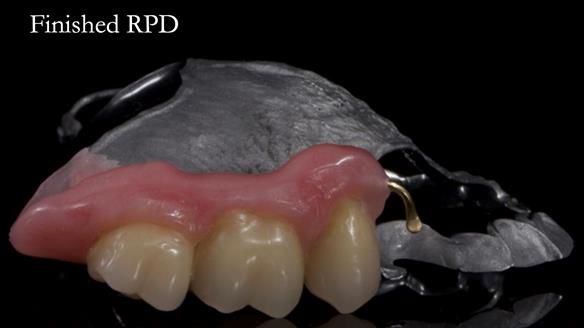 Finlay's Newsletter 64 case study - provision of a Kennedy class 2 metal based Scandinavian RPD for Ian