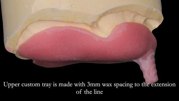 Newsletter 50 Special edition Complete Dentures FULL PROTOCOL