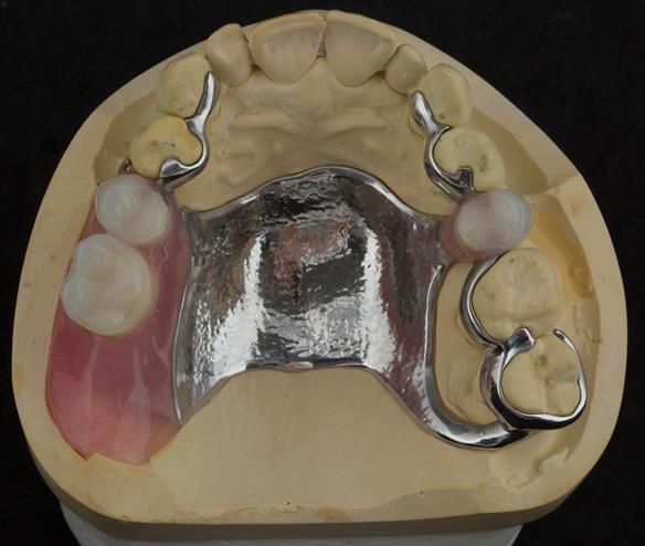 Figure 76 Finished definitive partial denture. Scandinavian design - keeping the denture components 3mm away from the gingival margin