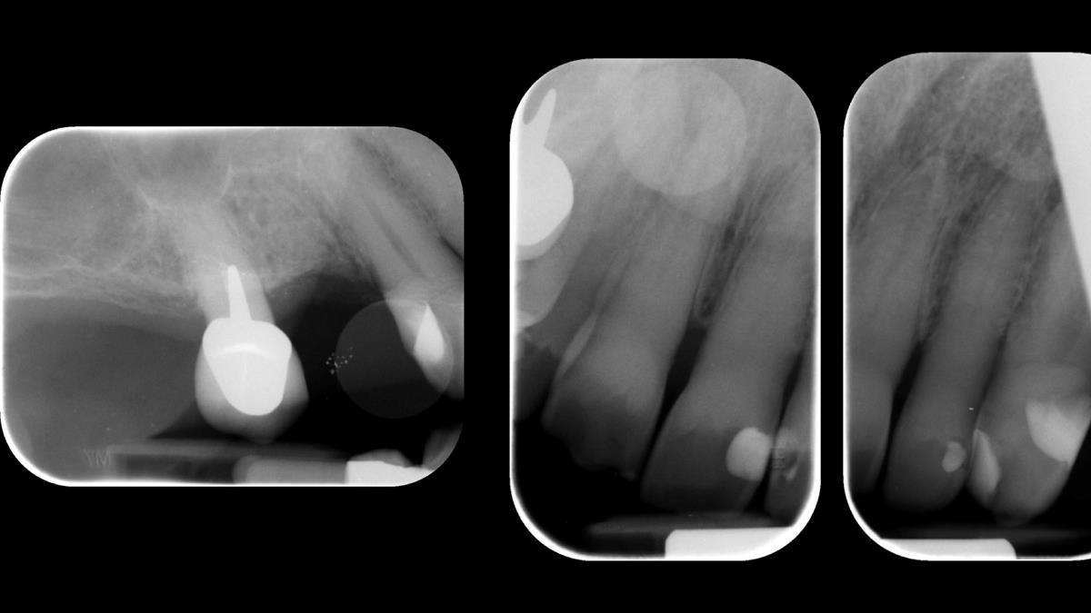 Newsletter 89 – Simon: A Challenging Kennedy Class II Division 1 Upper CoCr Partial Denture with a High Smile Line