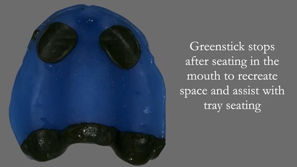 Newsletter 53 showing the making and fitting of ultra life-like dentures for Valena