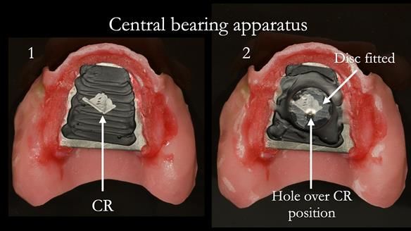 Newsletter 76: Jackie’s case – Telescopic overdenture & precision RPD (the tricky truth!)