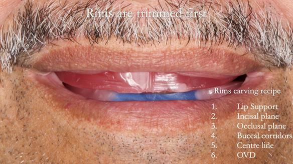 Finlay's Newsletter 62 provision of extractions and metal based complete dentures for Rafique