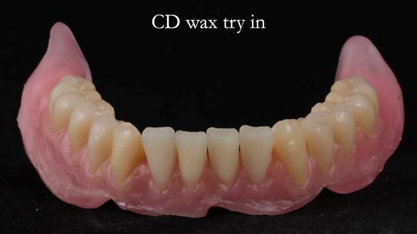 Finlay's Newsletter 62 provision of extractions and metal based complete dentures for Rafique