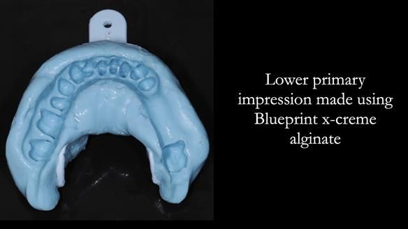 Newsletter 56 showing the making and fitting of a bilateral free end saddle upper removable partial denture (RPD) for patient with pemphigus