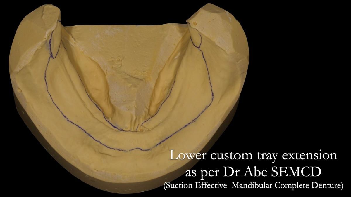 Fin’s Newsletter 88 — Complete dentures - full protocol… he rearranged his own teeth!