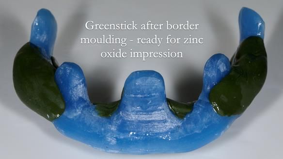 Newsletter 80 - Gordon’s dentures: the one case in 1,000 where my technique failed