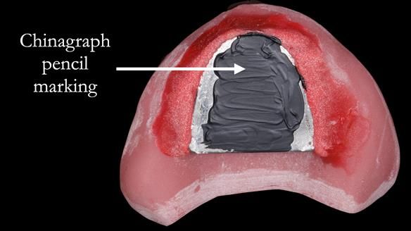 Newsletter 52 Managing Jo’s failing dentition with extractions and Mk 1/Mk 2 complete upper dentures and lower partial dentures FULL PROTOCOL