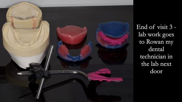 Newsletter 83: Sheila’s Complete Denture Success