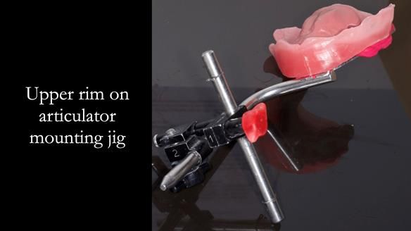 Newsletter 52 Managing Jo’s failing dentition with extractions and Mk 1/Mk 2 complete upper dentures and lower partial dentures FULL PROTOCOL