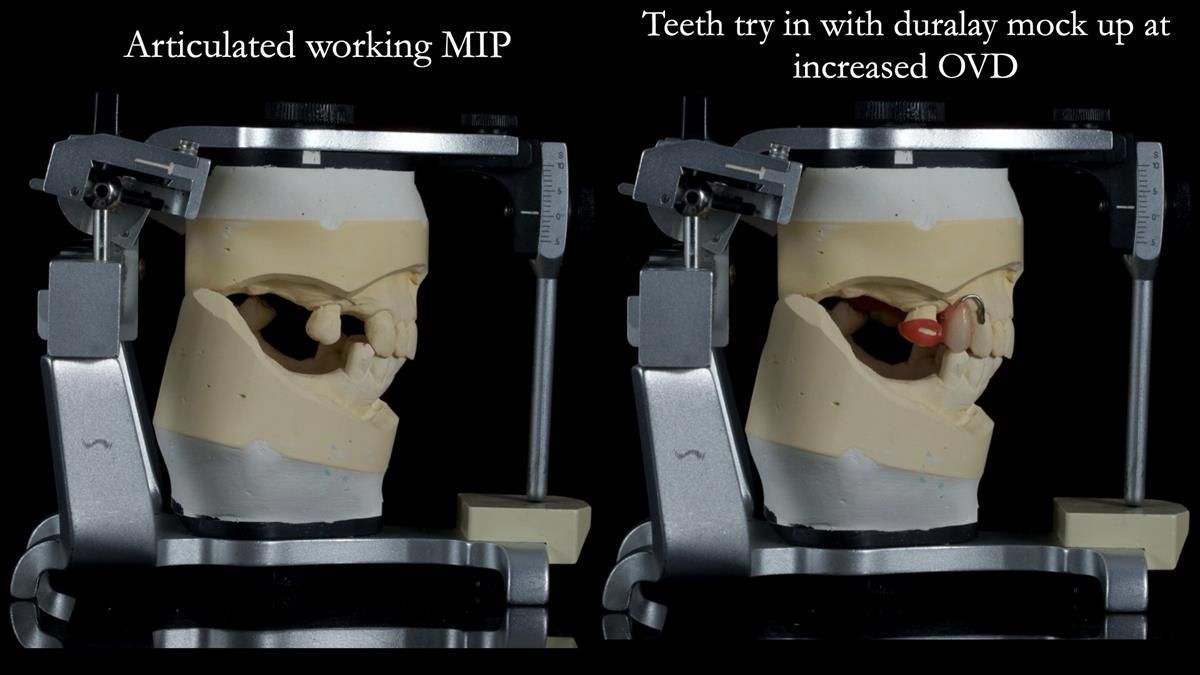 Newsletter 89 – Simon: A Challenging Kennedy Class II Division 1 Upper CoCr Partial Denture with a High Smile Line