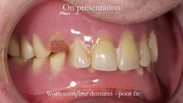 Newsletter 57 showcases the making and fitting process of implant-supported complete dentures for Alisdair