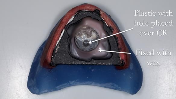 Newsletter 80 - Gordon’s dentures: the one case in 1,000 where my technique failed