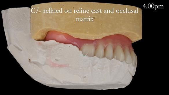 Newsletter 52 Managing Jo’s failing dentition with extractions and Mk 1/Mk 2 complete upper dentures and lower partial dentures FULL PROTOCOL