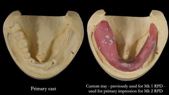 Newsletter 82 Mary - A complete upper and a one-tooth gasket denture