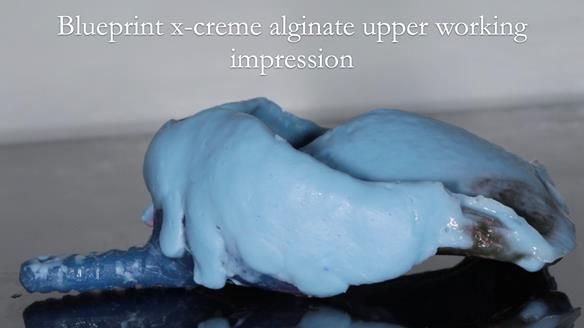 Newsletter 56 showing the making and fitting of a bilateral free end saddle upper removable partial denture (RPD) for patient with pemphigus