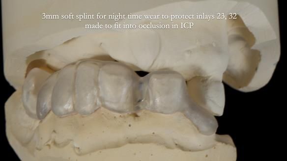 Newsletter 55 Provision of metal based partial dentures for Zephyrine with a repaired cleft lip and palate