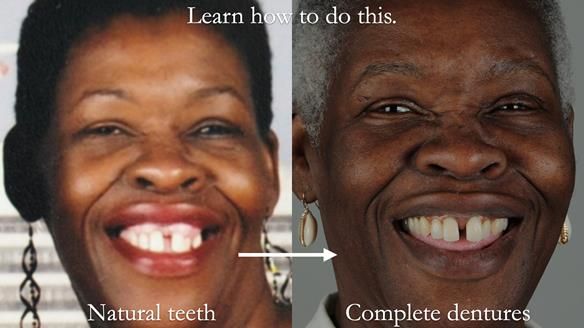 Finlay's Newsletter 59 Ultra hard partial dentures made for Gill