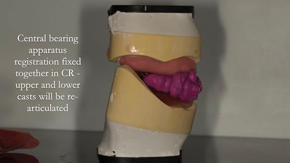 Newsletter 75: Marion’s case - Step-by-step complete denture workflow