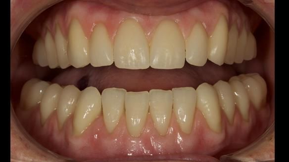 Finished dentures - mimicking Mary’s daughters natural teeth