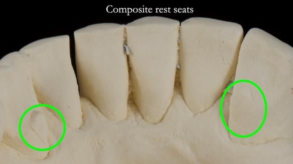 Finlay's Newsletter 61 provision of a lower unilateral free end saddle metal based partial denture for Joyce