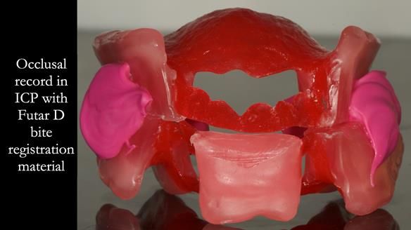 Finlay's Case Study Newsletter 40 - Immediate Mk 1 RPD to Definitive Mk 2 RPD - full protocol