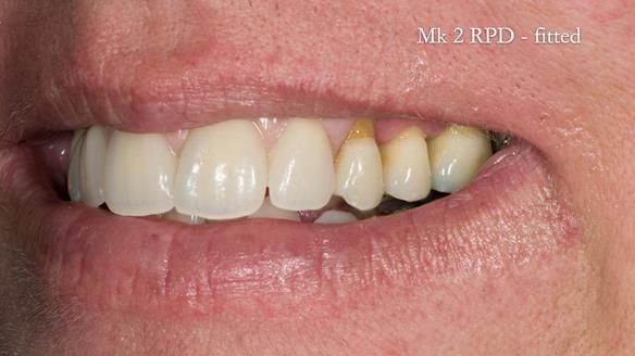 Finlay's Newsletter 63 Case study provision of metal based Scandinavian RPD - functional 10 years on