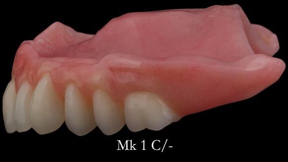 Newsletter 52 Managing Jo’s failing dentition with extractions and Mk 1/Mk 2 complete upper dentures and lower partial dentures FULL PROTOCOL