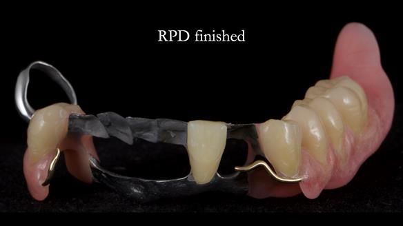 Newsletter 55 Provision of metal based partial dentures for Zephyrine with a repaired cleft lip and palate