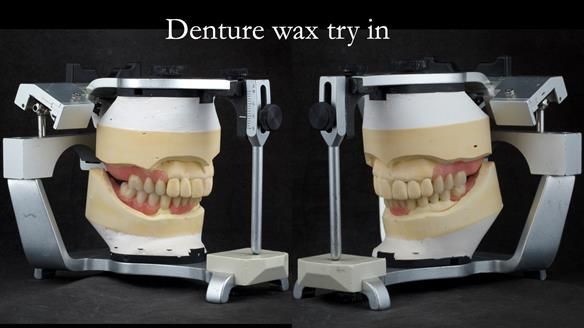 Newsletter 76: Jackie’s case – Telescopic overdenture & precision RPD (the tricky truth!)