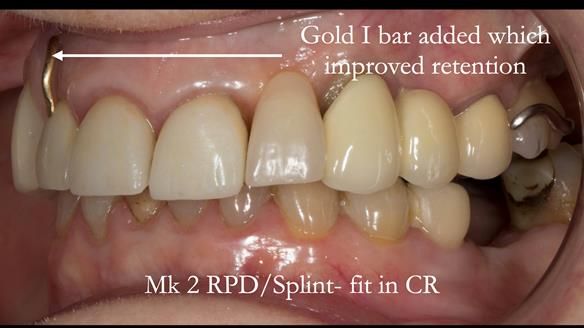 Newsletter 51 Managing Anne’s failing dentition with distal extension base RPD/Splint FULL PROTOCOL