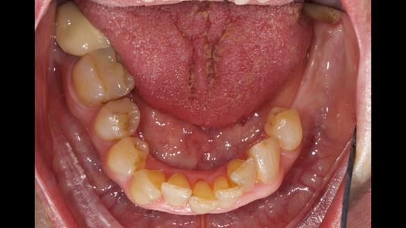 Finlay's Newsletter 60 Sylvia's upper Kennedy Class 2 Mod 1 metal based upper RPD