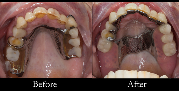Figure 30 Finished upper denture. Optimal extension of saddles and palatal strap for maximum support. Dental bar gives additional support and should teeth be lost in the future this can be added to