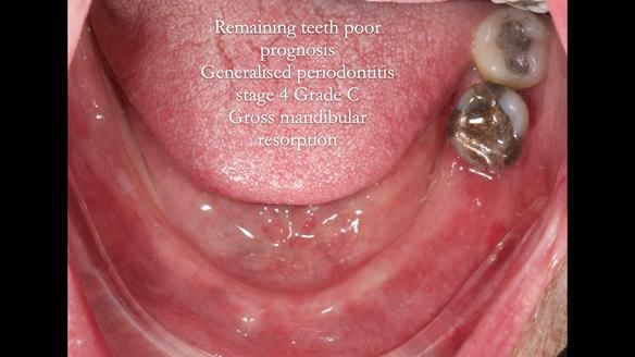 Finlay's Newsletter 59 Ultra hard partial dentures made for Gill