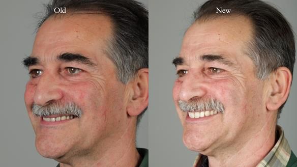 Newsletter 78: What do Clark Gable and a Locator® overdenture have in common?