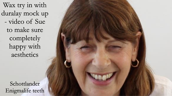 Newsletter 56 showing the making and fitting of a bilateral free end saddle upper removable partial denture (RPD) for patient with pemphigus