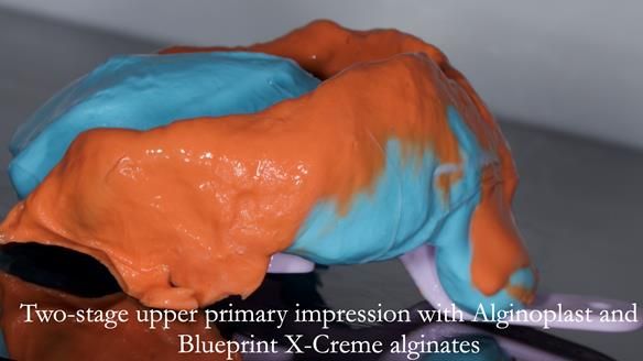 Newsletter 75: Marion’s case - Step-by-step complete denture workflow