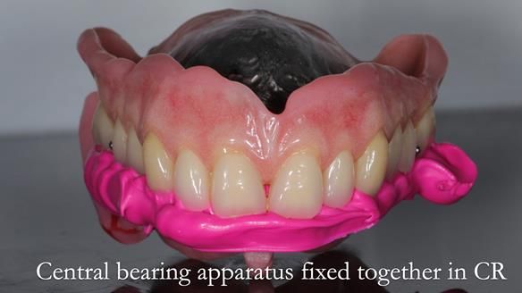 Newsletter 54 case presentation upper complete denture and lower Scandinavian designed hygienic partial denture for David